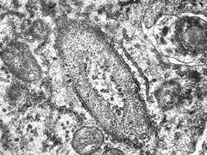 M,41y. | hairy cell leukemia - spleen - ribosome-lamella complex in tricholeukocyte